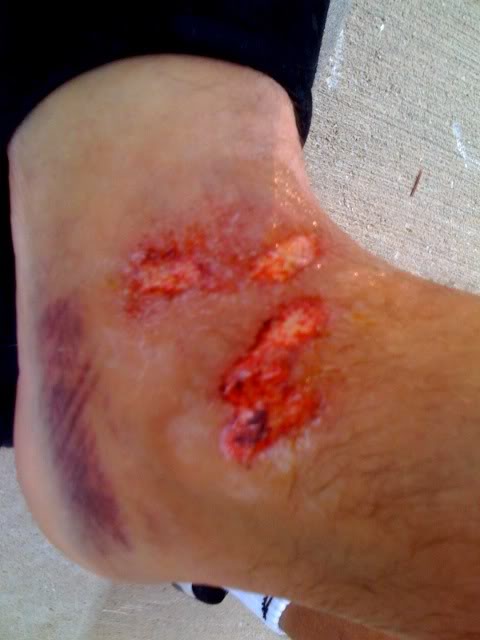 Name:  danbrokenfoot1.jpg
Views: 4
Size:  34.2 KB