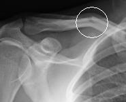 Name:  rightclaviclesm.jpg
Views: 6
Size:  3.9 KB